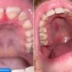 why is the roof of my mouth bruised